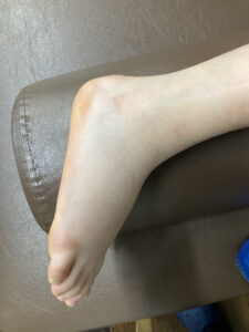 足関節捻挫