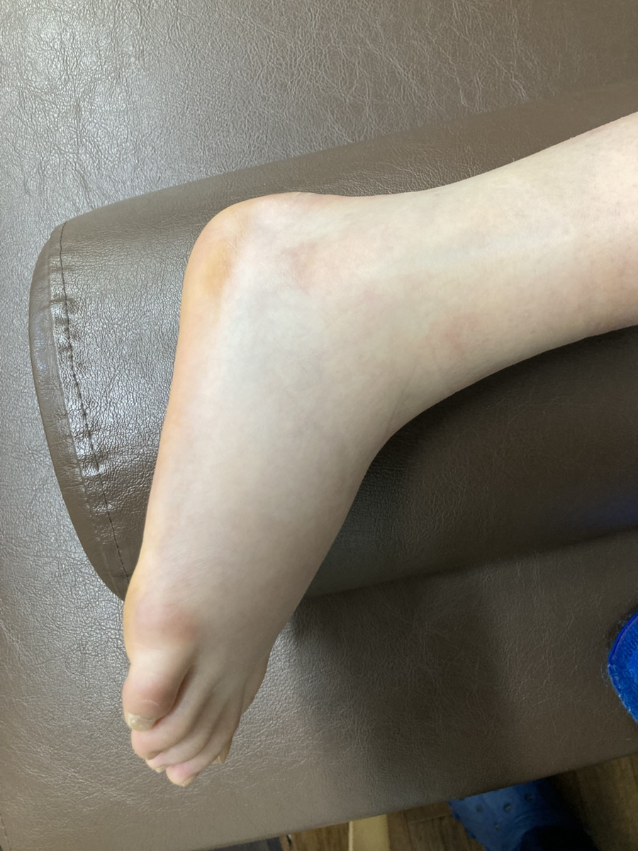 足関節捻挫