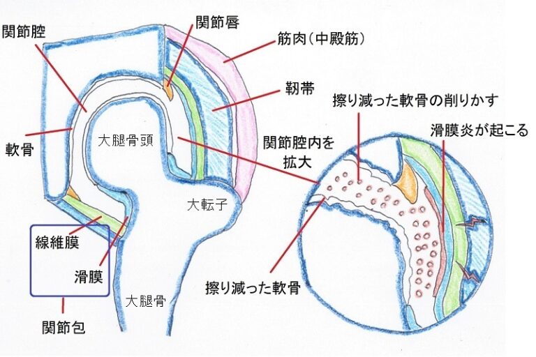 軟骨損傷、骨挫傷