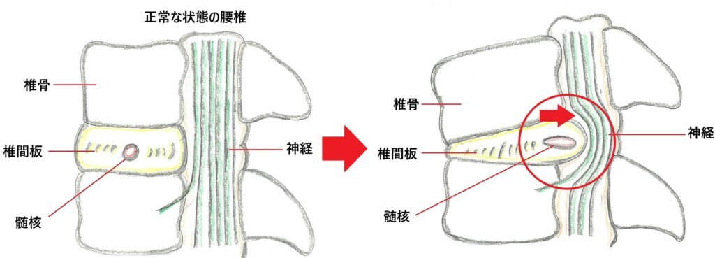 腰椎椎間板ヘルニア