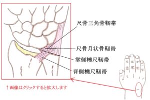 TFCC（三角線維軟骨複合体）損傷
