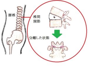 疲労骨折（腰椎分離症）