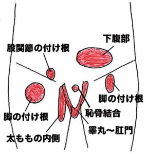 グロインペイン症候群（鼠径部痛症候群）