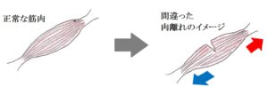 肉離れ（筋挫傷）