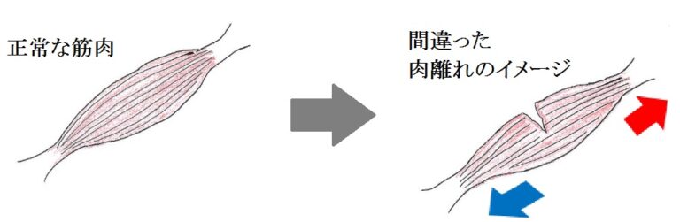 肉離れ（筋挫傷）