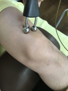 膝に水が溜まる（膝関節水腫）