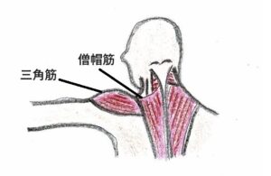 寝違え