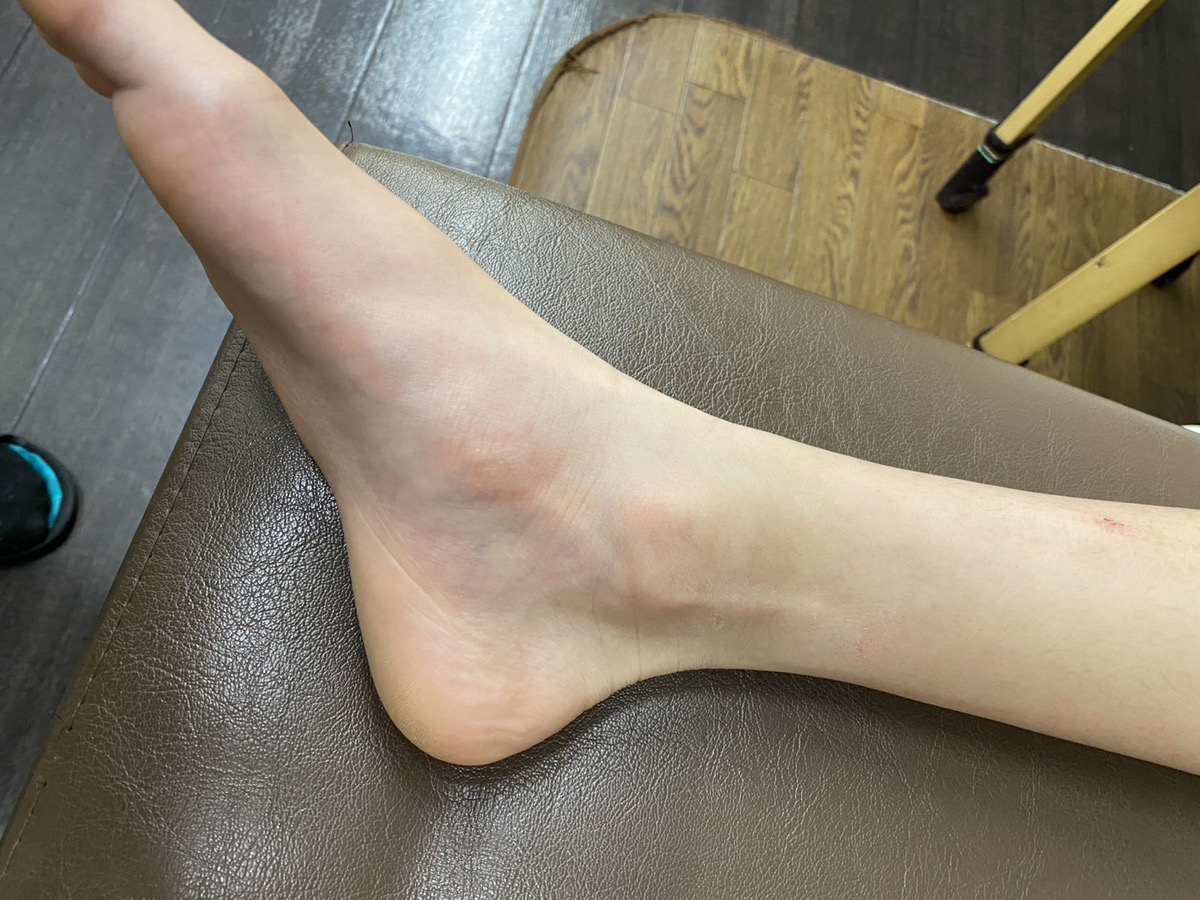 有痛性外脛骨(外脛骨障害)