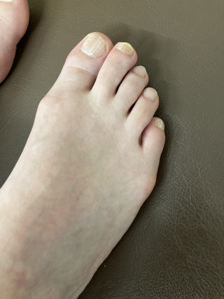 足の甲の痛み