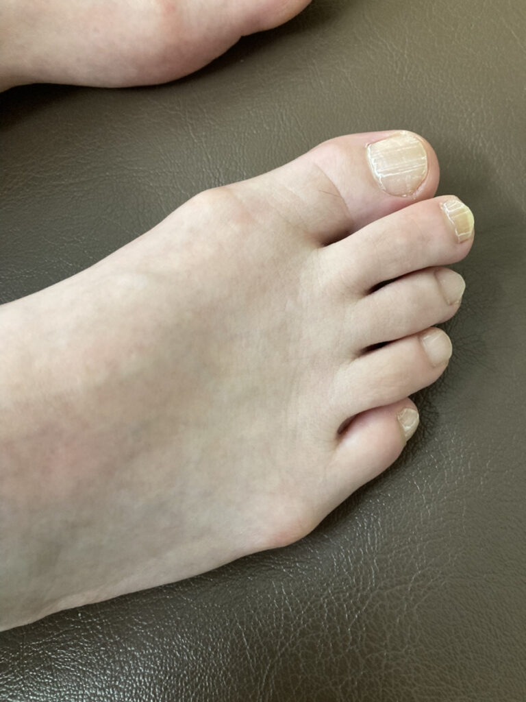 内反小趾