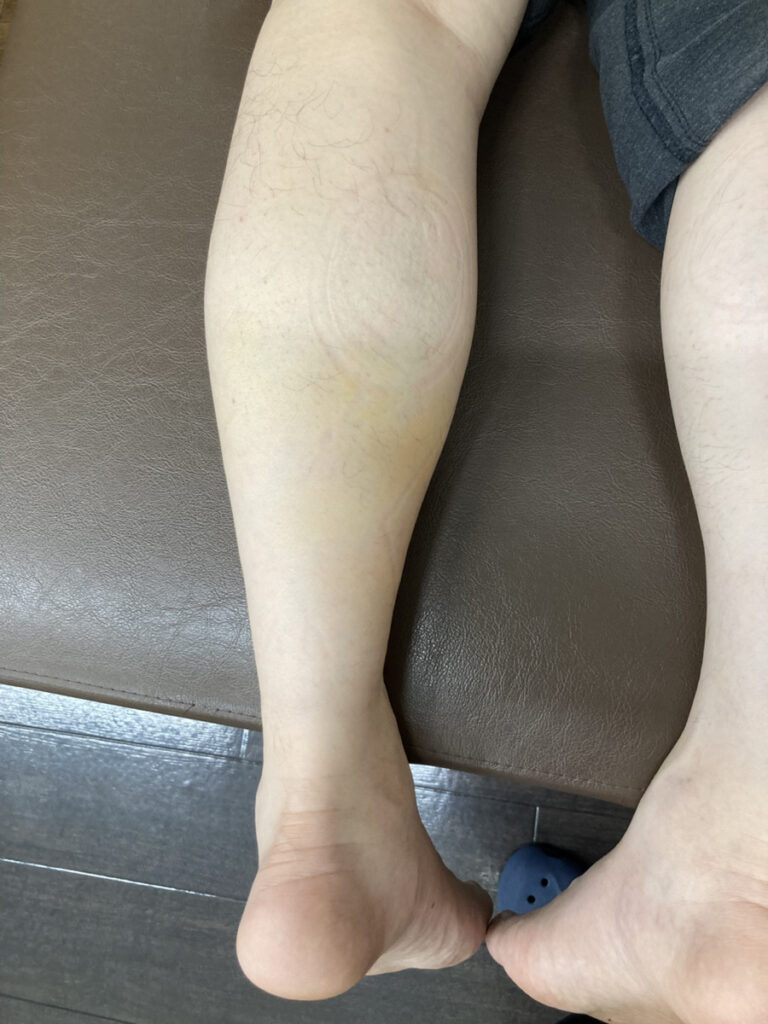 ふくらはぎの痛み