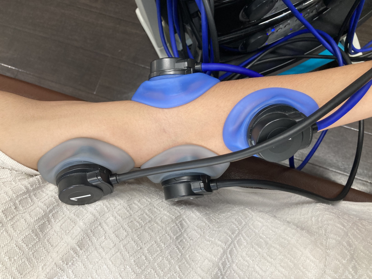 肘に電気療法を行っている様子