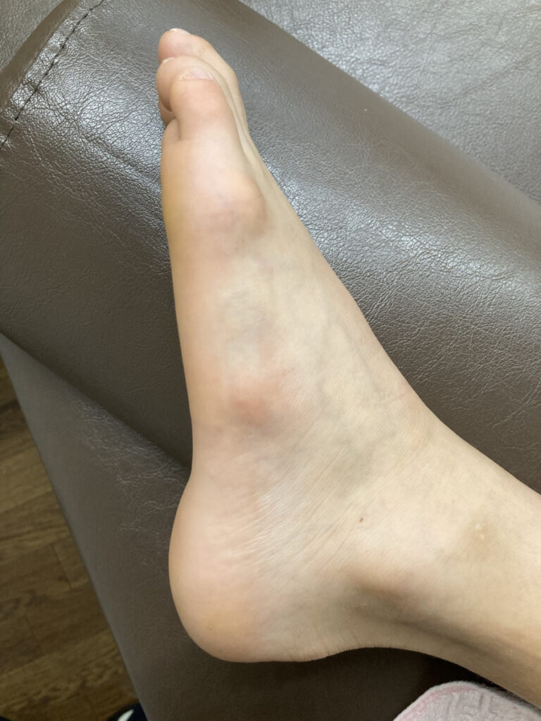 中足骨疲労骨折