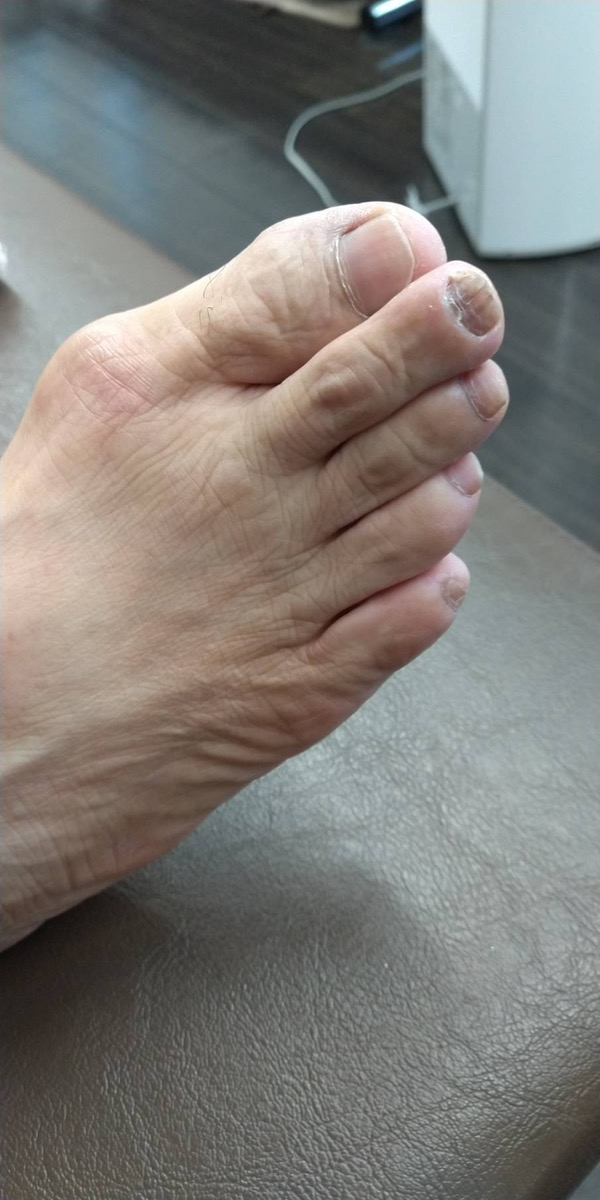 外反母趾