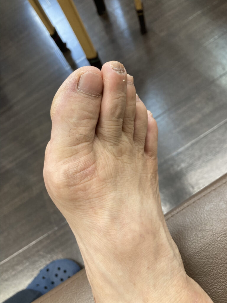 外反母趾