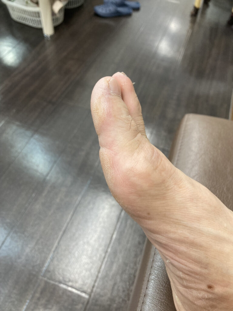 強剛母趾