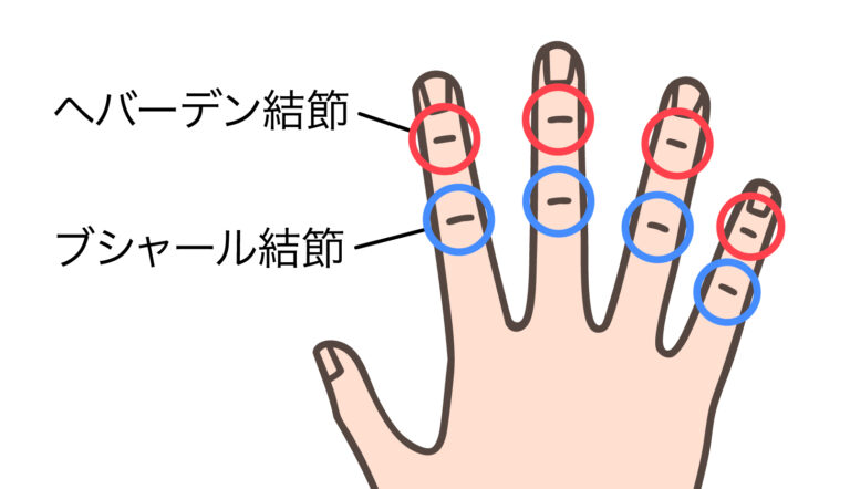ブシャール結節