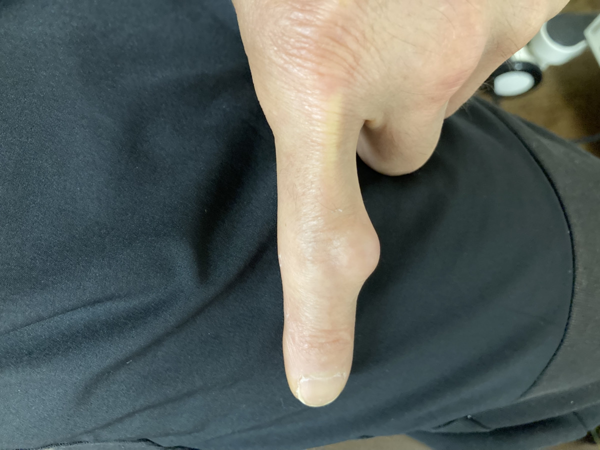 突き指を放置した事例