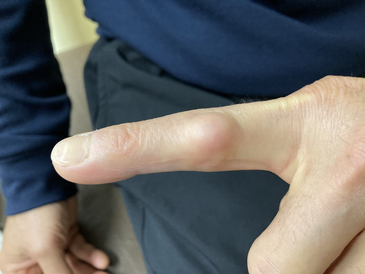 突き指を放置した事例