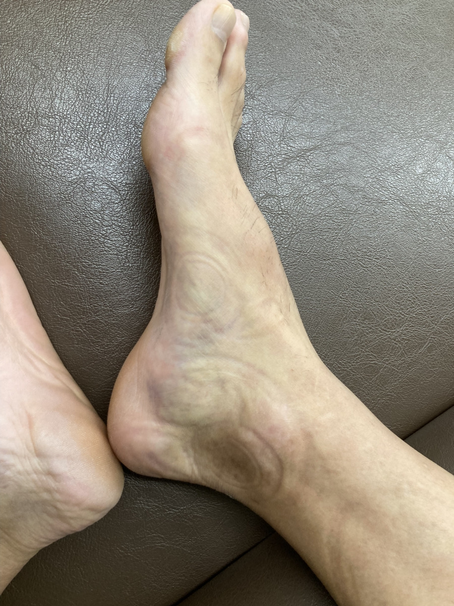足の内側の捻挫とアキレス腱付着部炎