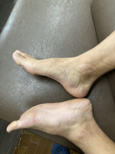 アキレス腱付着部症（アキレス腱付着部炎）