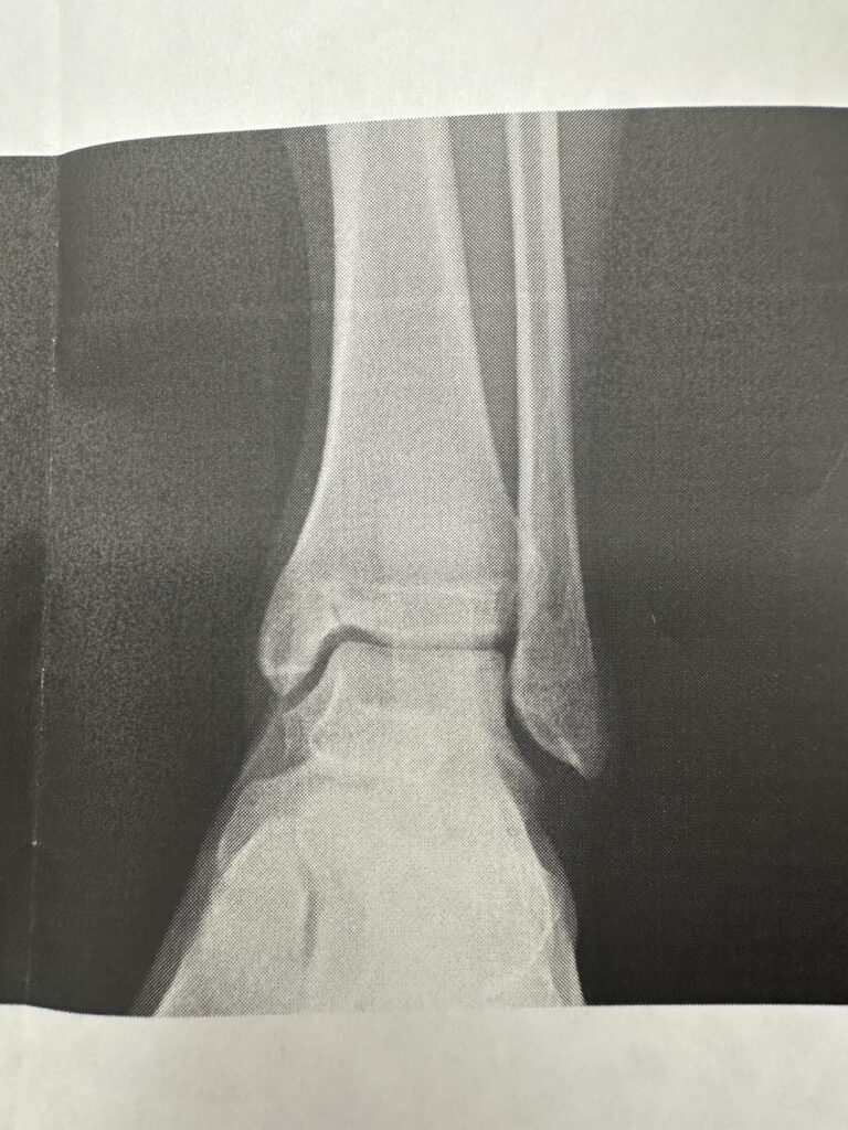 疲労骨折