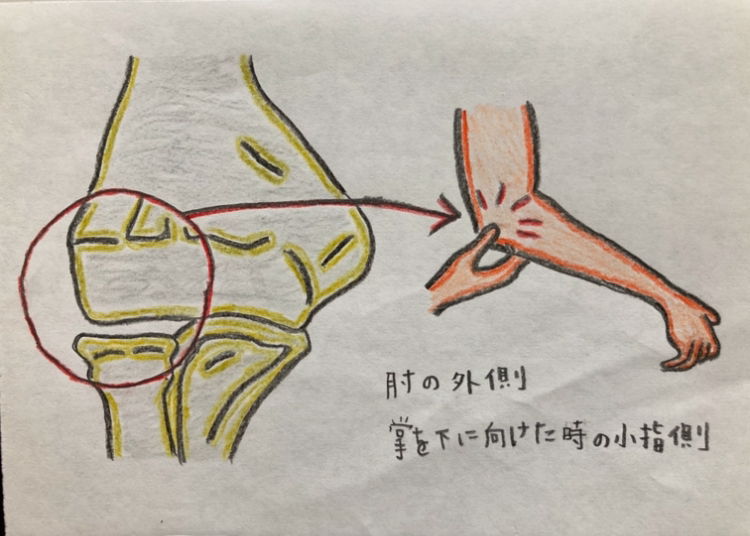 野球肘外側型