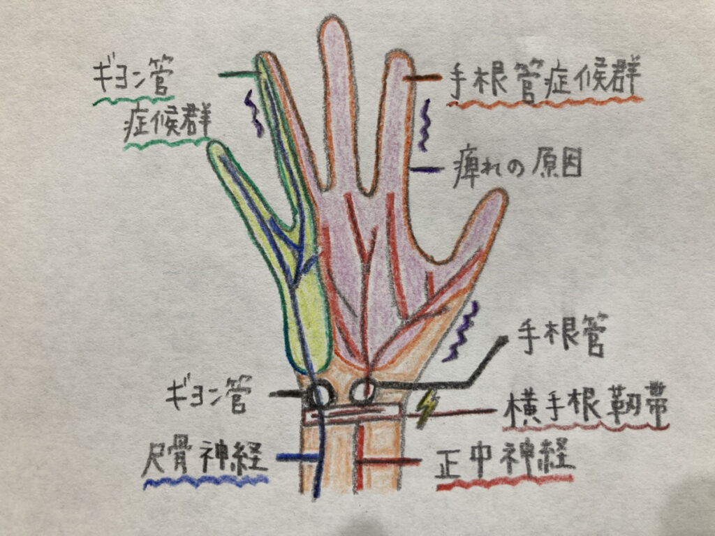 手根管症候群