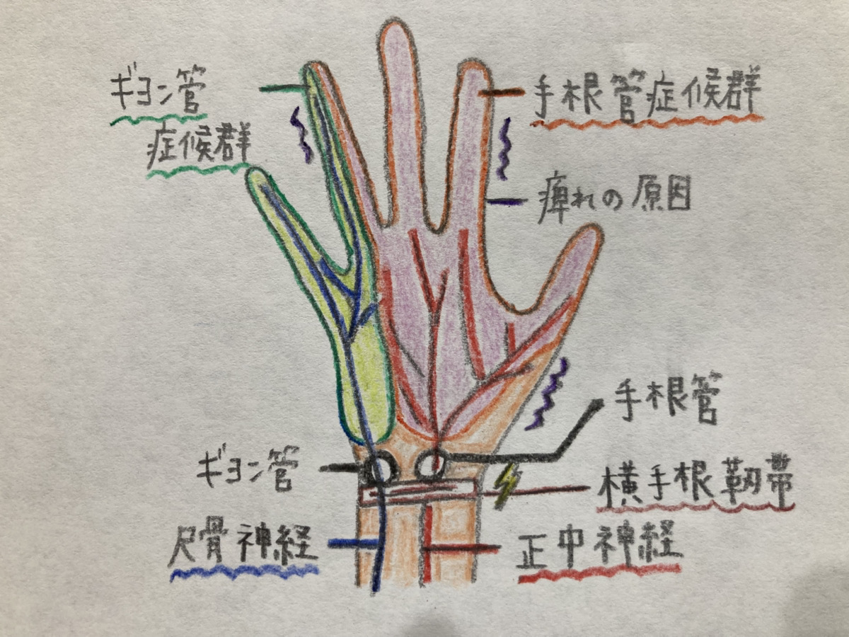 手根管症候群、手の痺れ