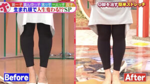 O脚（内反膝）