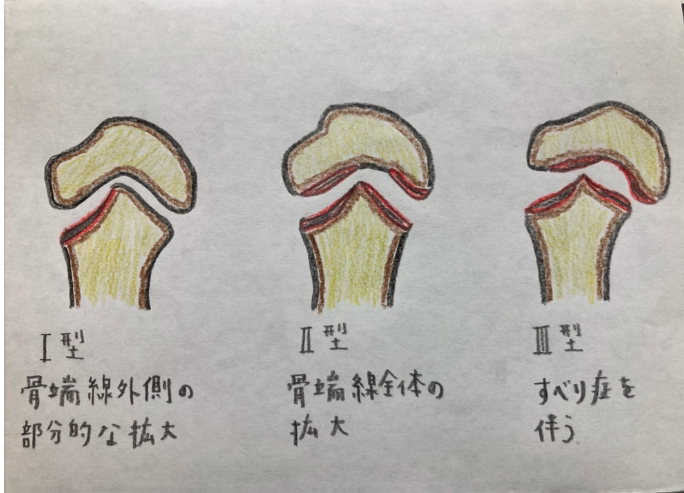 リトルリーガーズショルダーの分類（野球肩）