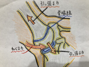 リトルリーガーズショルダー（上腕骨近位骨端線離開）