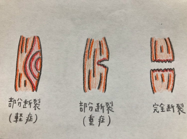 肉離れの分類