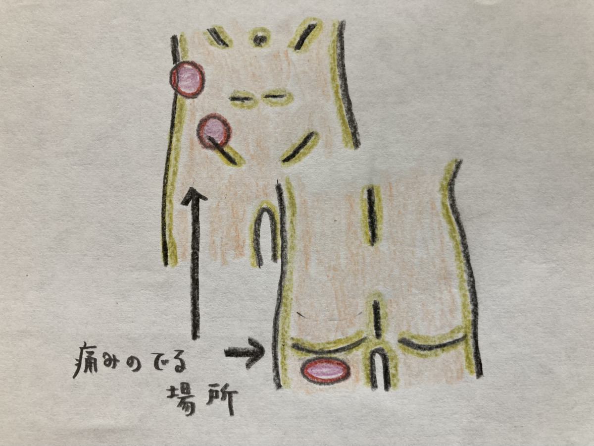 骨盤裂離骨折の好発部位