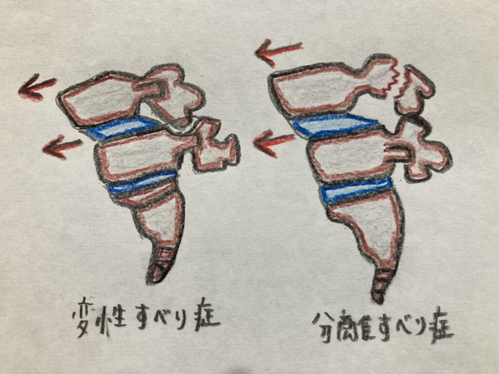 腰椎分離すべり症