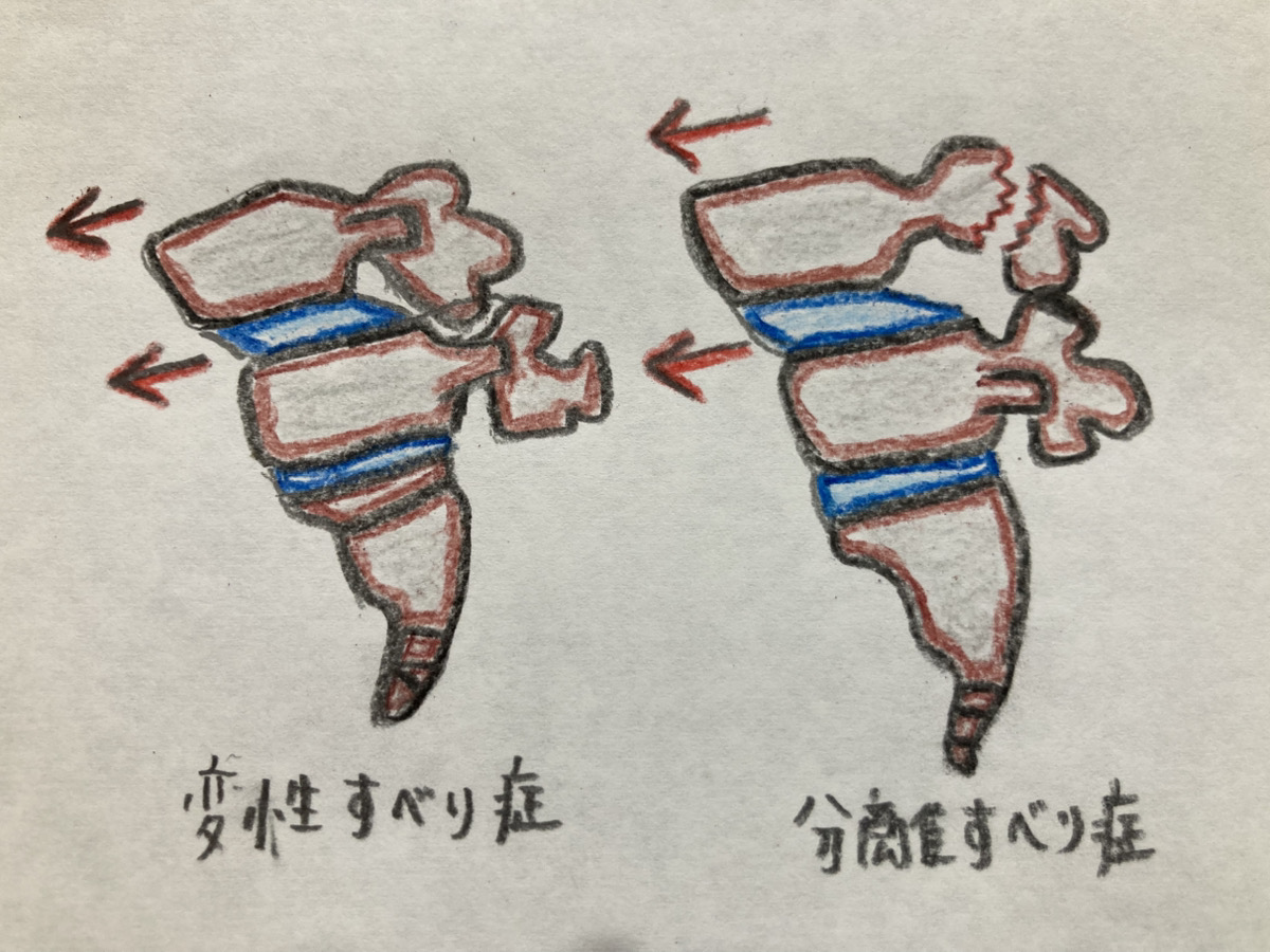 腰椎すべり症と腰椎分離すべり症