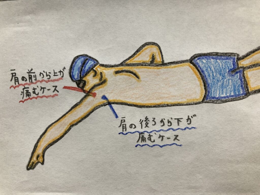 水泳肩（スイマーズショルダー）