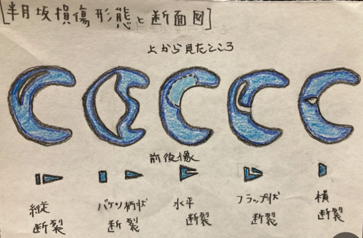 半月板損傷形態と断面図