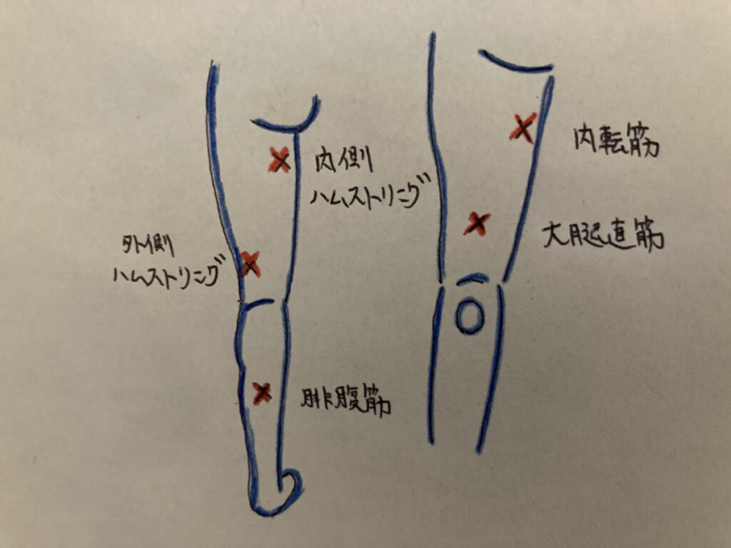 太ももの肉離れ
