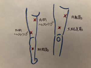 太ももの肉離れ