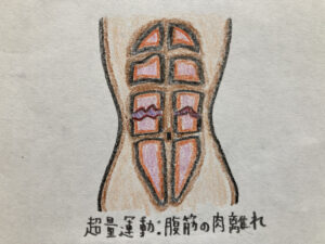 腹筋の肉離れ