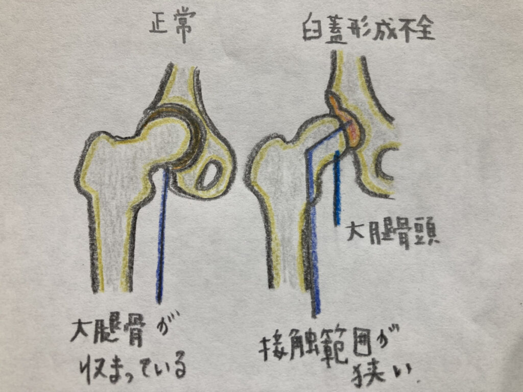 臼蓋形成不全