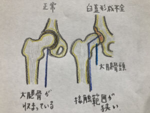 臼蓋形成不全