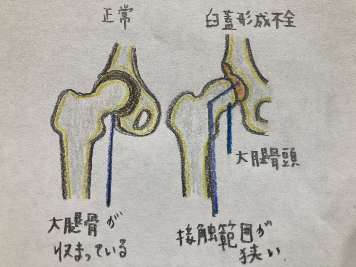 臼蓋形成不全