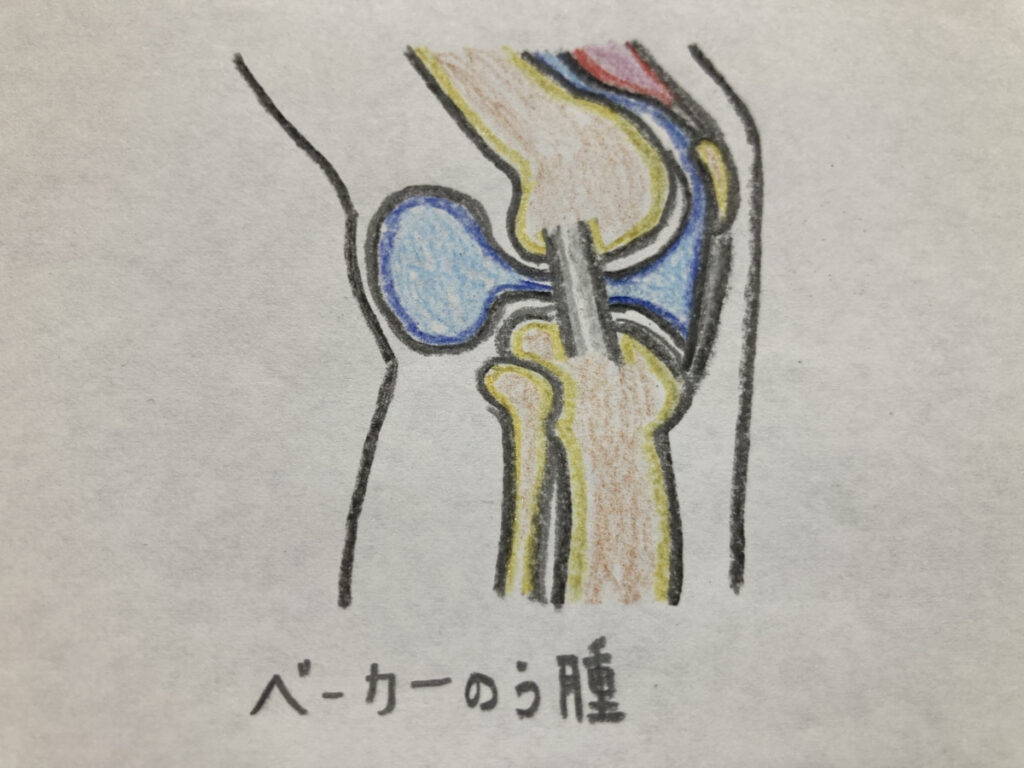ベーカー嚢腫