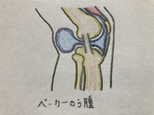 ベーカー嚢腫
