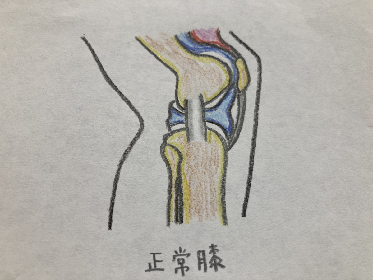 ベーカー嚢腫