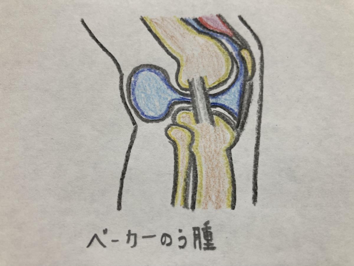 ベーカー嚢腫