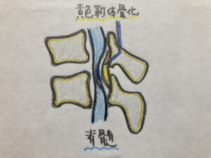 黄色靭帯骨化症