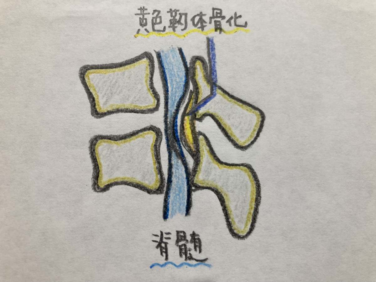 黄色靭帯骨化症